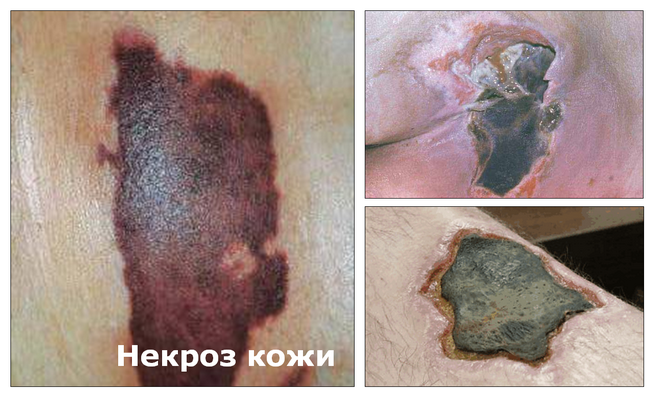 Некроз кожи