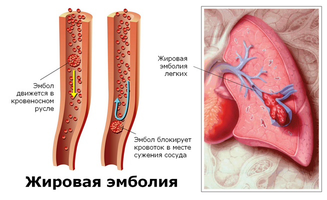 Жировая эмболия