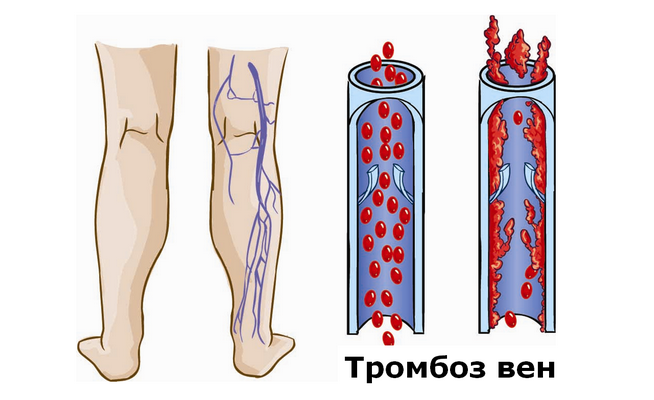 Тромбоз